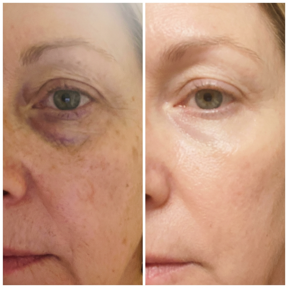 2. Visibly Erases Dark Circles